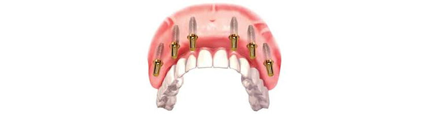 All on 6 - dentalni most na  implantata