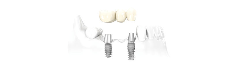 Dentalni most na implantatima