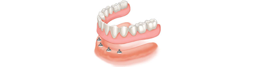 Zubna proteza na 4 implantata sa kuglama ili Locator vezama