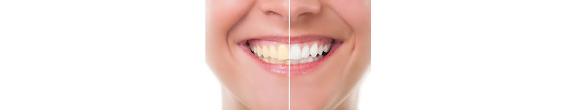 Izbjeljivanje zubi - Opalescence Boot gel