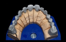 metal krunica corona zahnkrone