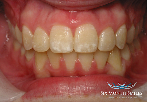 Six month smiles ortodoncija primjer 1 završetak