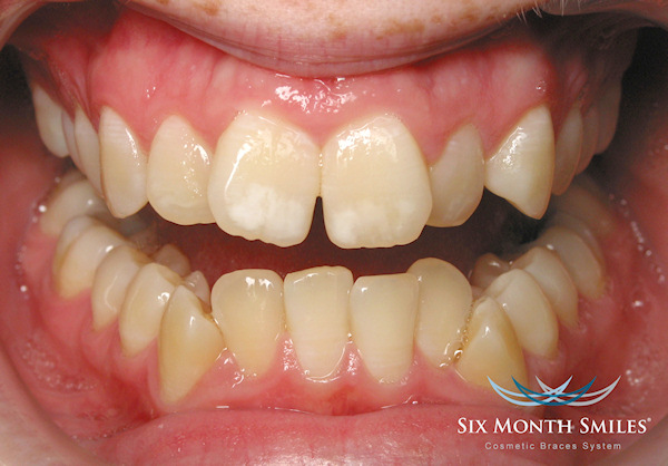 Six month smiles ortodoncija primjer 1 prije terapije