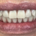 In Dental - slučaj All On 6