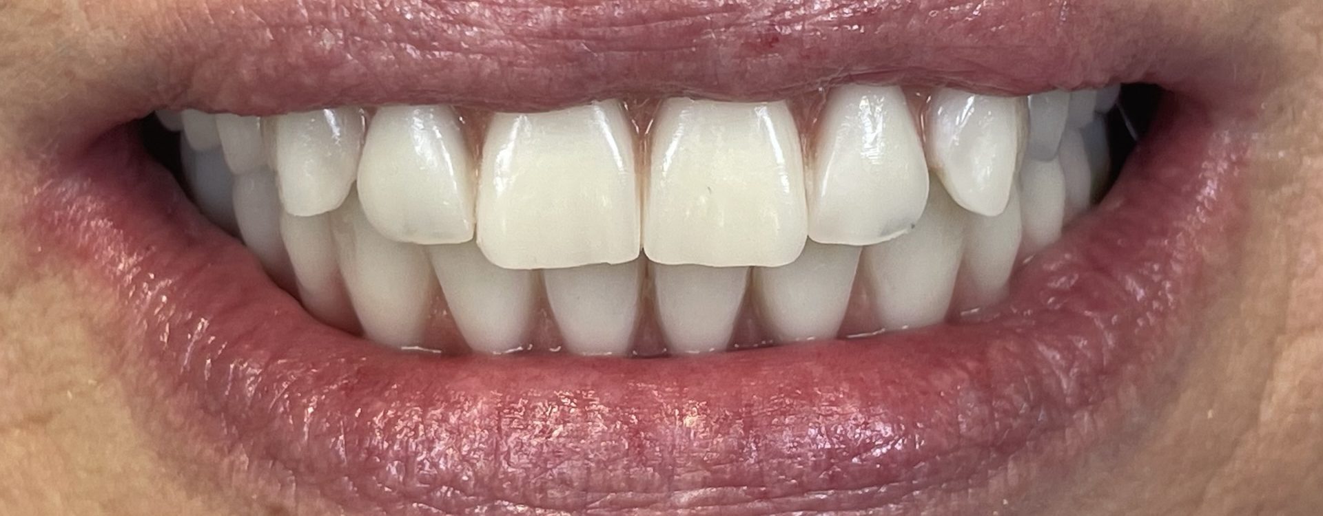 In Dental - slučaj All On 6