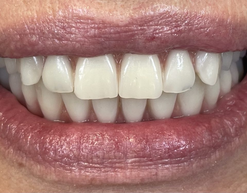 In Dental - slučaj All On 6